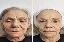 Best HIFU Treatment before & After clinic Dubai