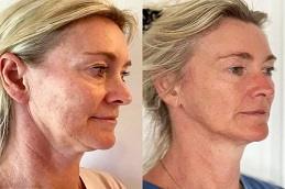 Best HIFU Treatment before & After clinic in Dubai