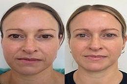 Best HIFU Treatment before & After in Dubai