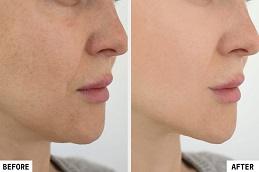 Best HIFU Treatment before & After