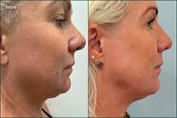 Best HIFU Treatment in Dubai