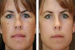 Birthmarks Removal Treatment before & After clinic in Dubai