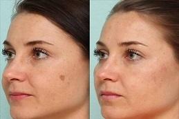 Birthmarks Removal before & After Clinic in Dubai