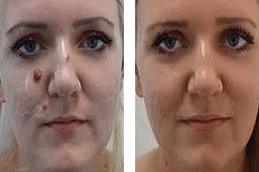Birthmarks Removal before & After in Dubai