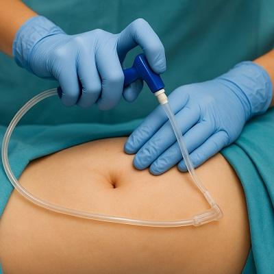 Body Jet liposuction in Dubai & Abu Dhabi