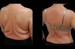 Bra Lift Surgery before & After clinic in Dubai