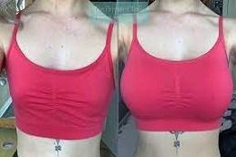 Breast Augmentation before & After Dubai