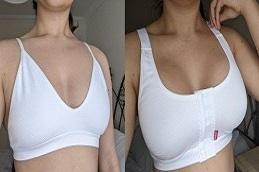 Breast Augmentation before & After clinic Dubai