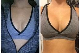 Breast Augmentation before & After in Dubai