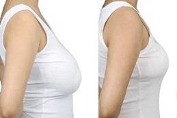 Breast Lift Surgery clinic in Dubai