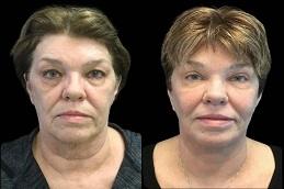 CO2 Fractional Laser Before & After clinic Dubai