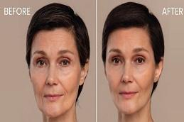 CO2 Fractional Laser Before & After clinic in Dubai