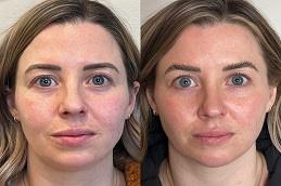 Dermal Filler Before & After in Dubai & Abu Dhabi
