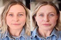 Dermal Filler Before & After in Dubai