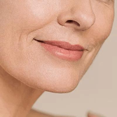 Facial Capillaries in Dubai