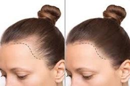 Female Hair Transplant before & after Dubai