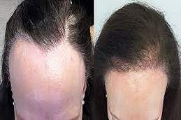 Female Hair Transplant before & after clinic in Dubai