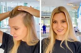 Female Hair Transplant before & after in Dubai