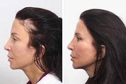 Female Hair Transplant before & after