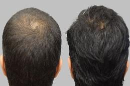 GFC Hair Transplant Before & After Dubai & Abu Dhabi