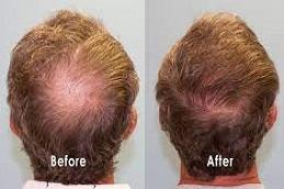 GFC Hair Transplant Before & After in Dubai & Abu Dhabi