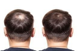 GFC Hair Transplant Before & After,