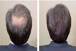 GFC Hair Treatment clinic in Dubai,