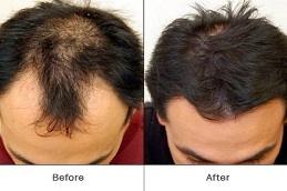 GFC Hair Treatment clinic in Dubai