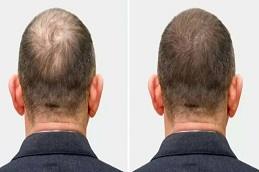 GFC Hair Treatment in Dubai