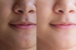 Glutathione Injection For Skin Whitening before & After