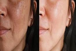 Glutathione Injection For Skin Whitening before & After Dubai