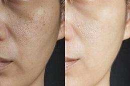 Glutathione Injection For Skin Whitening before & After Dubai