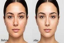 Glutathione Injection For Skin Whitening before & After.