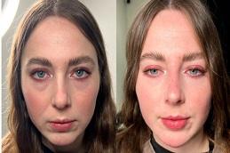 Gut Cleanse IV Drip clinic before & After Dubai