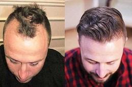 Hair Transplant Without Shaving Before & After Dubai