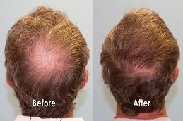 Hair Transplant Without Shaving Before & After clinic Dubai,