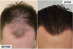 Hair Transplant Without Shaving Before & After clinic Dubai