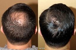 Hair Transplant Without Shaving Before & After clinic in Dubai