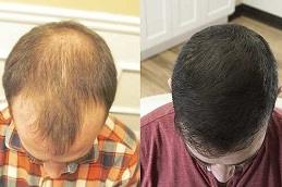 Hair Transplant Without Shaving Before & After in Dubai