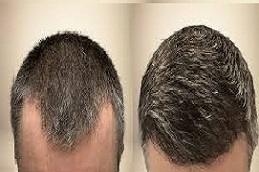 Hair Transplant Without Shaving Before & After