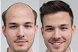 Human Hair Wigs befoe & After clinic in Dubai