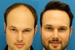 Human Hair Wigs befoe & After clinic in Dubai