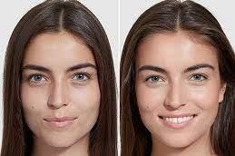 Inno Peel for Skin Whitening Treatment before and After.