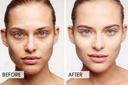 Inno Peel for Skin Whitening Treatment before and After Dubai.