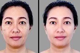 Inno Peel for Skin Whitening Treatment before and After Dubai