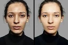 Inno Peel for Skin Whitening Treatment before and After in Dubai