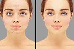 Inno Peel for Skin Whitening Treatment before and After