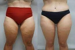 J Plasma for Thigh and Arms before & After,
