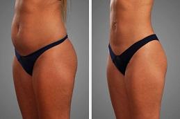 J Plasma for Thigh and Arms before & After Dubai