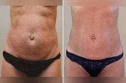 J Plasma for Thigh and Arms before & After in Dubai